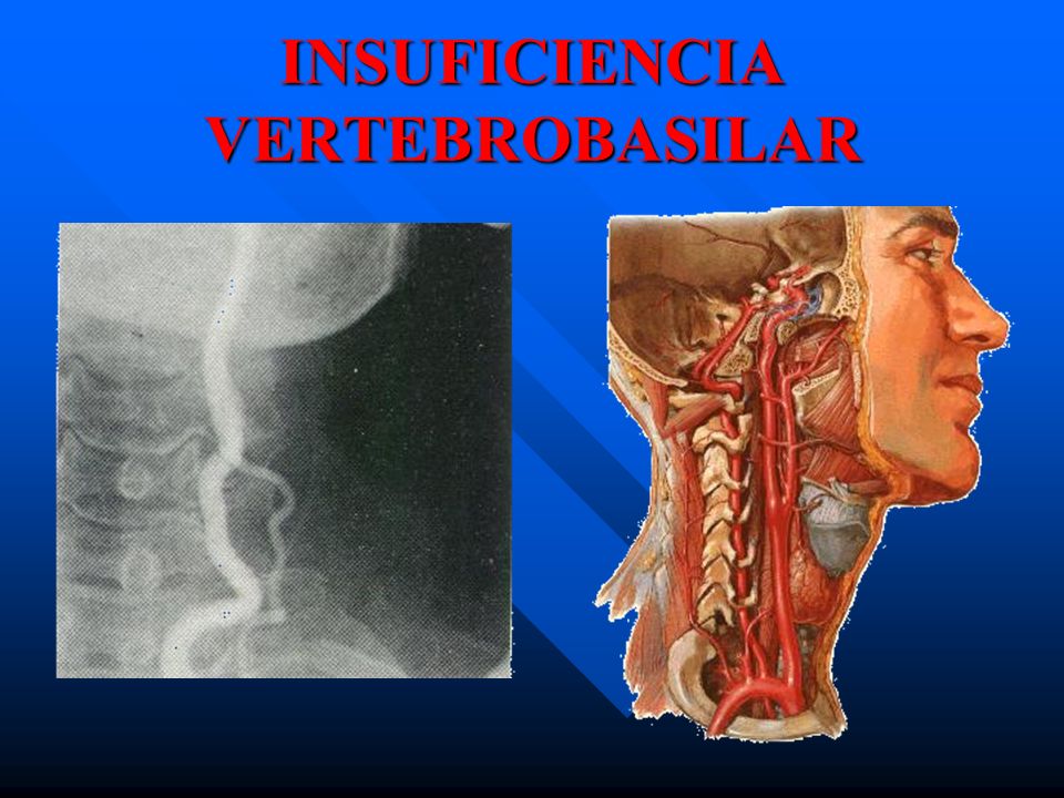 insuficiencia vertebrobasilar tratamiento